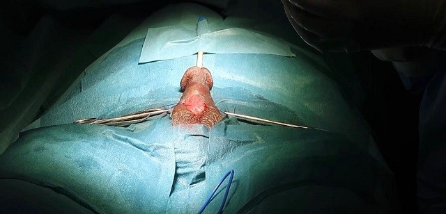 A Guide to Dick Enhancement penis surgery